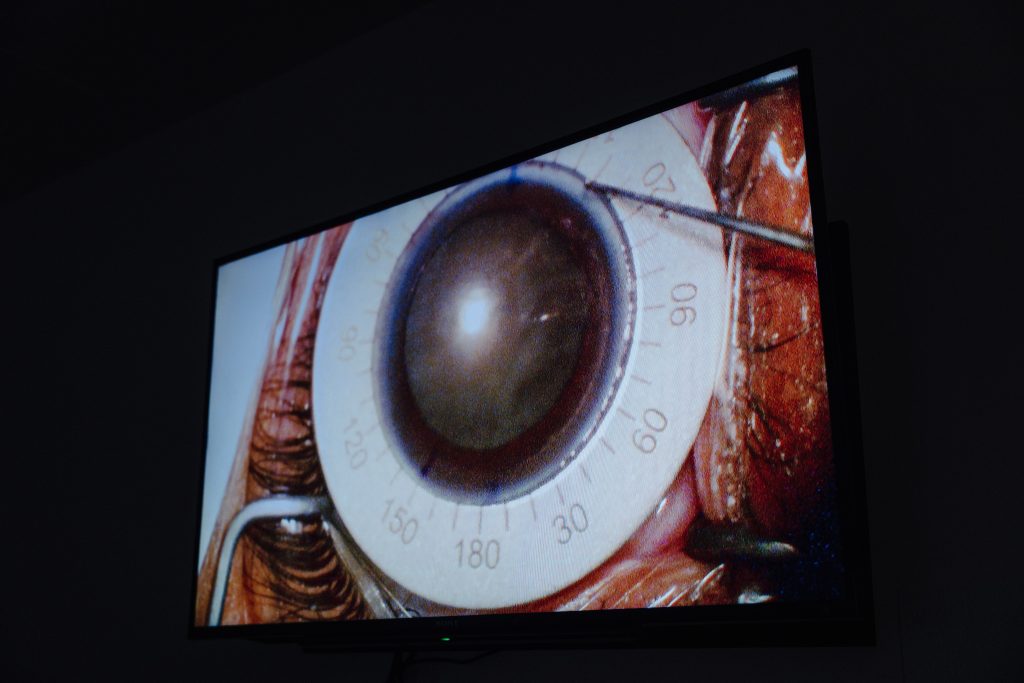 Photo of eye during surgery
