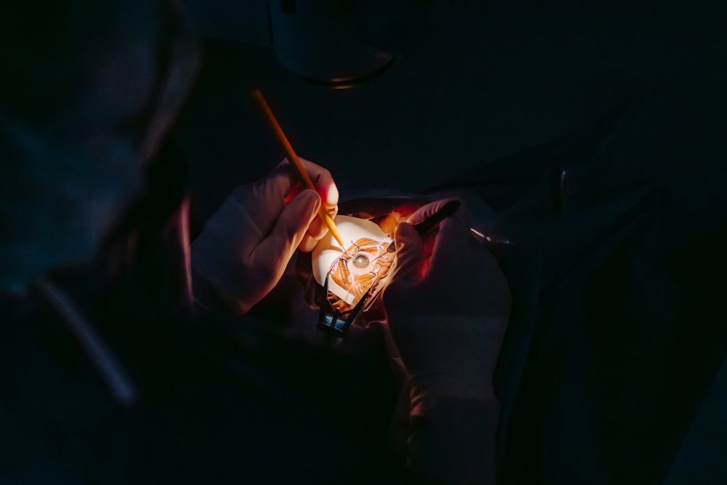 Photo of eye during surgery